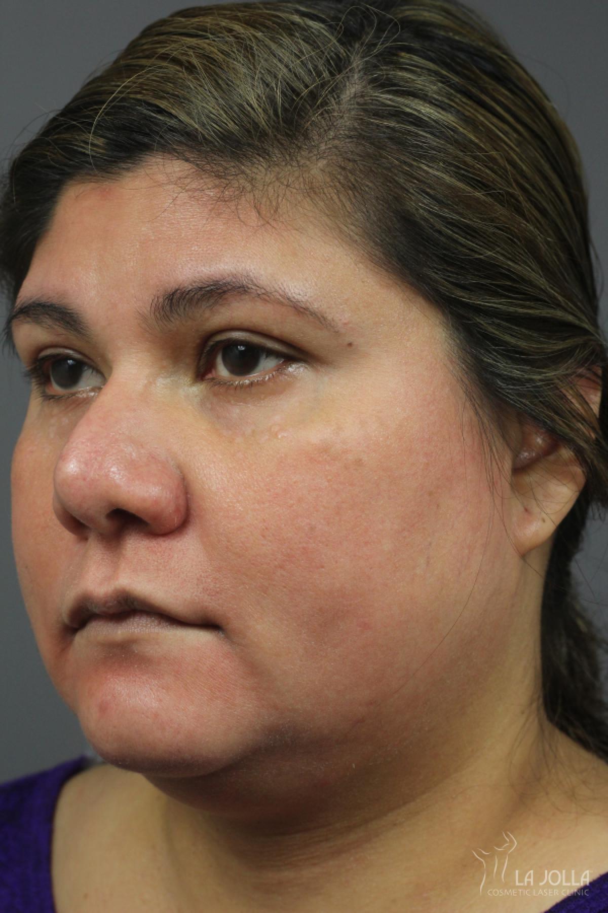 Chemical Peel: Patient 6 - After 1