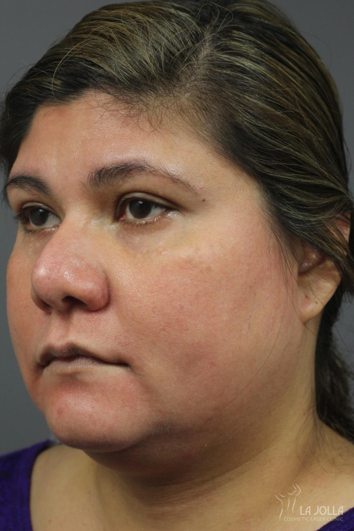 Chemical Peel: Patient 5 - After 1