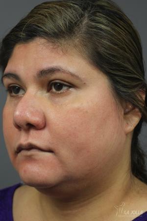 Chemical Peel: Patient 5 - After 1