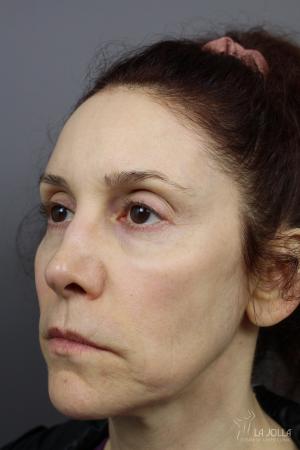 Liquid Facelift: Patient 2 - After  