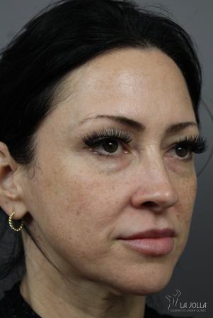 Sculptra®: Patient 4 - After  