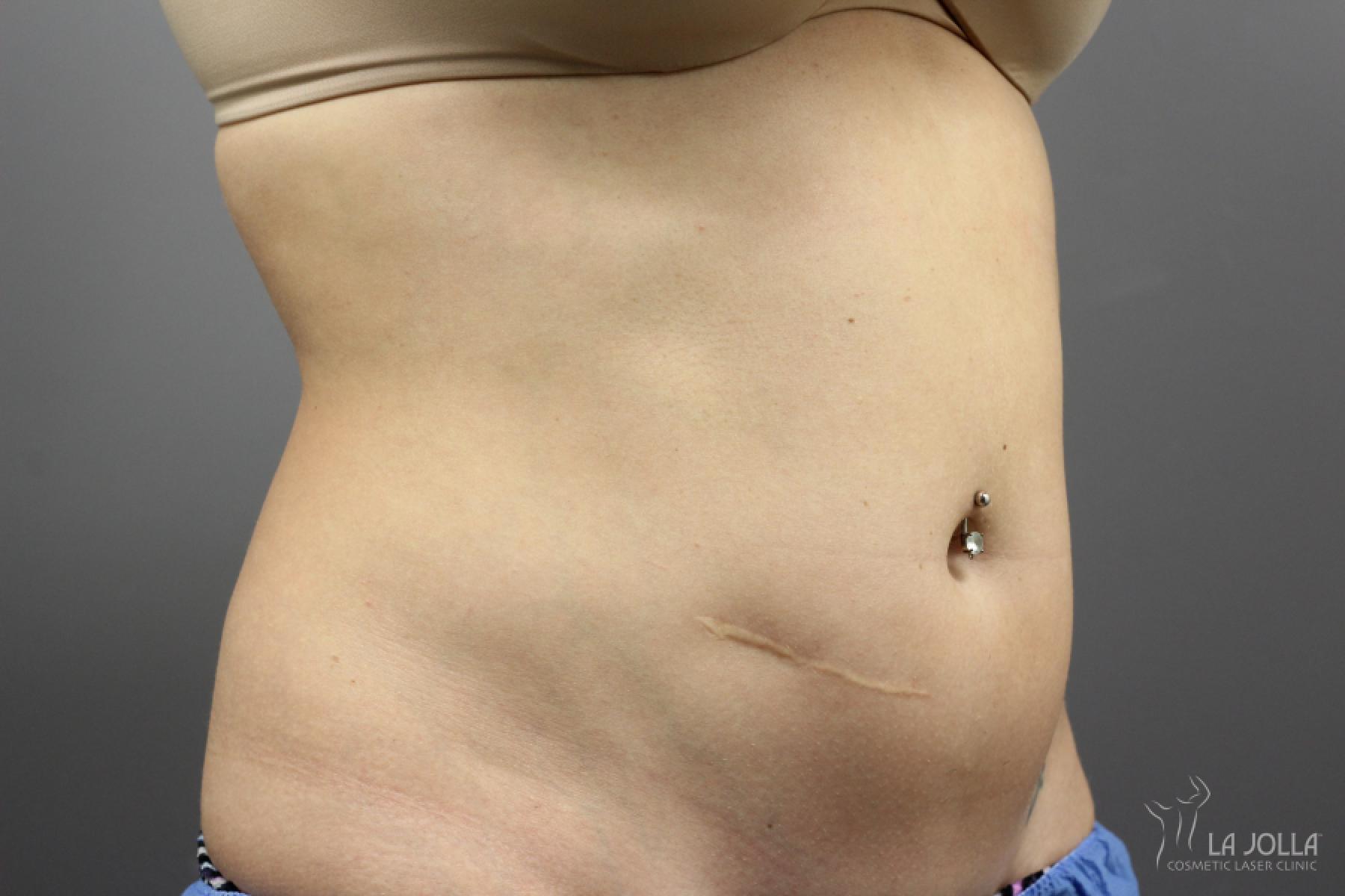 CoolSculpting®: Patient 2 - Before 