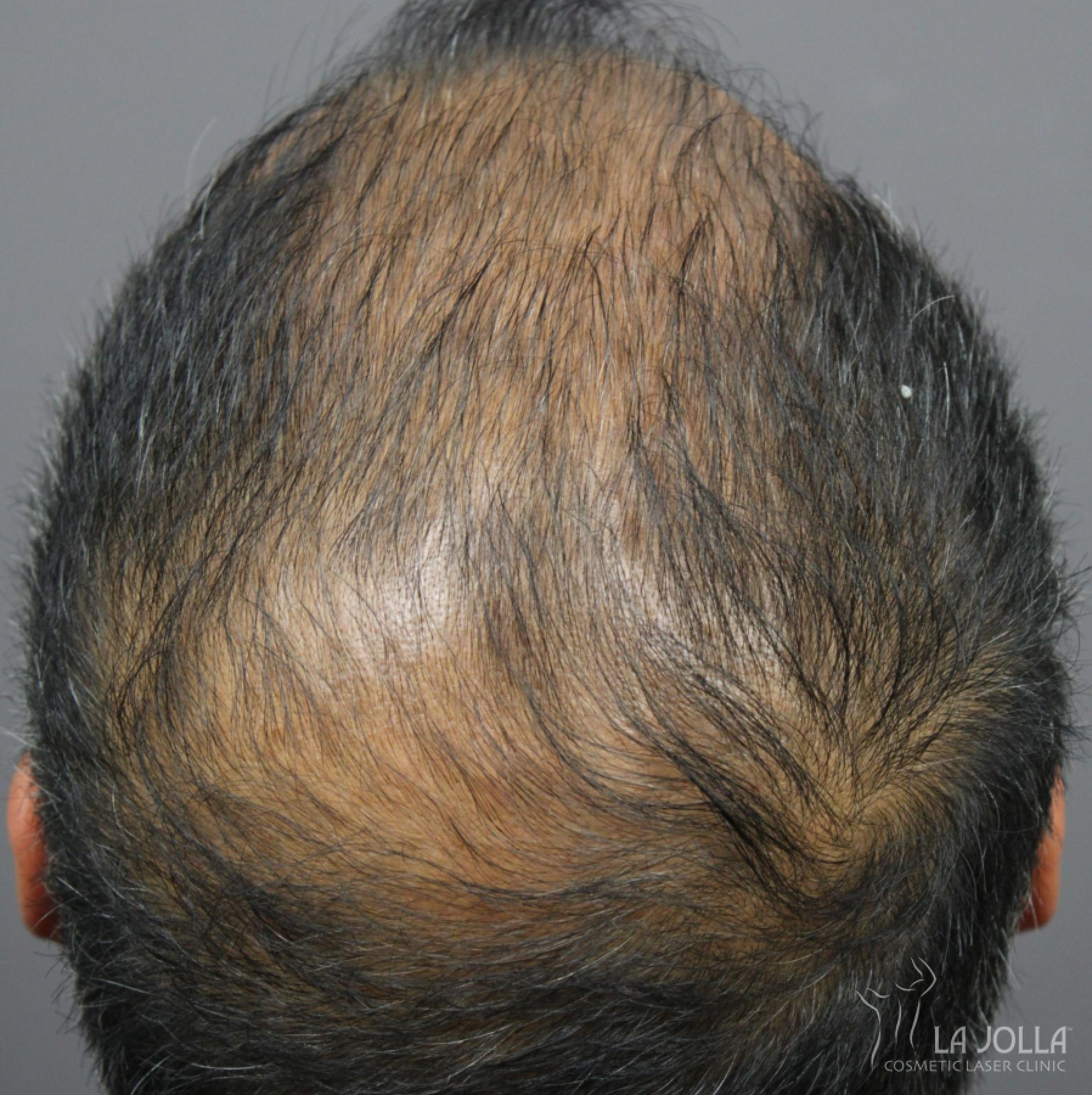 Hair Restoration: Patient 6 - Before 