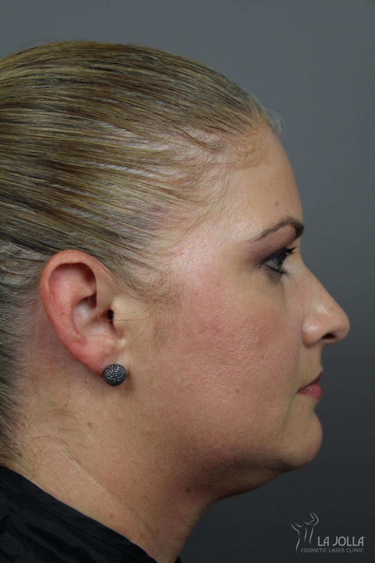 Kybella Patient 2 After Procedure