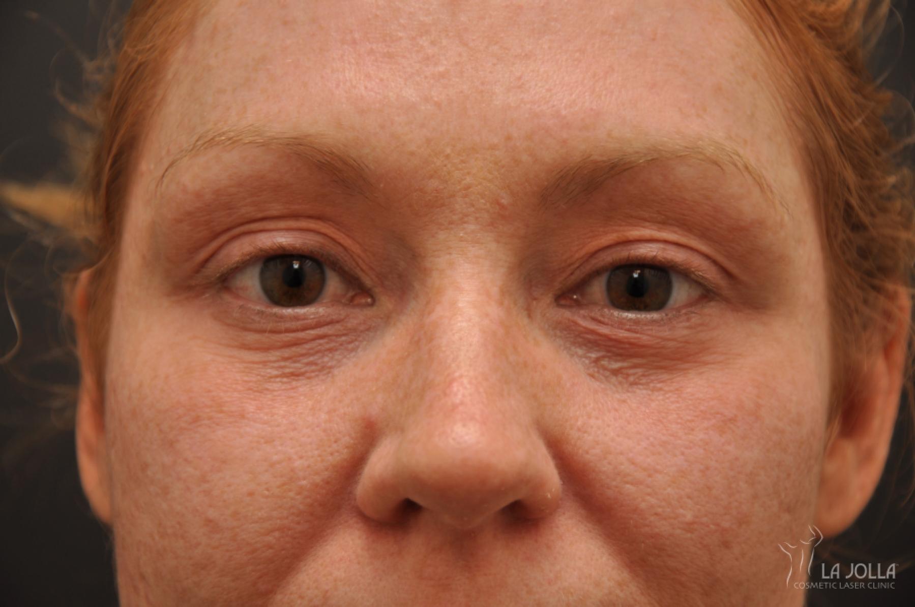 Under Eye Filler: Patient 3 - Before 1