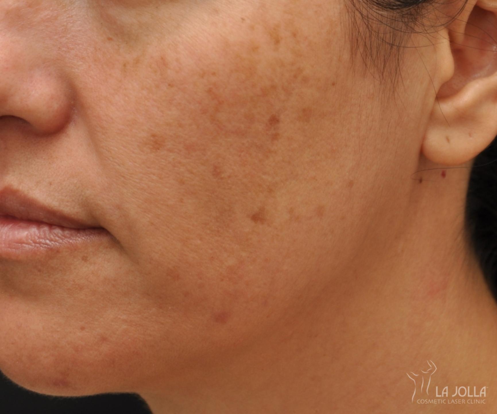 IPL: Patient 10 - Before 