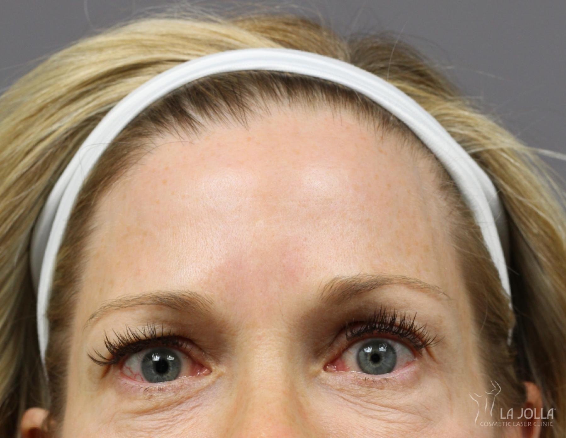 BOTOX® Cosmetic: Patient 4 - After 1