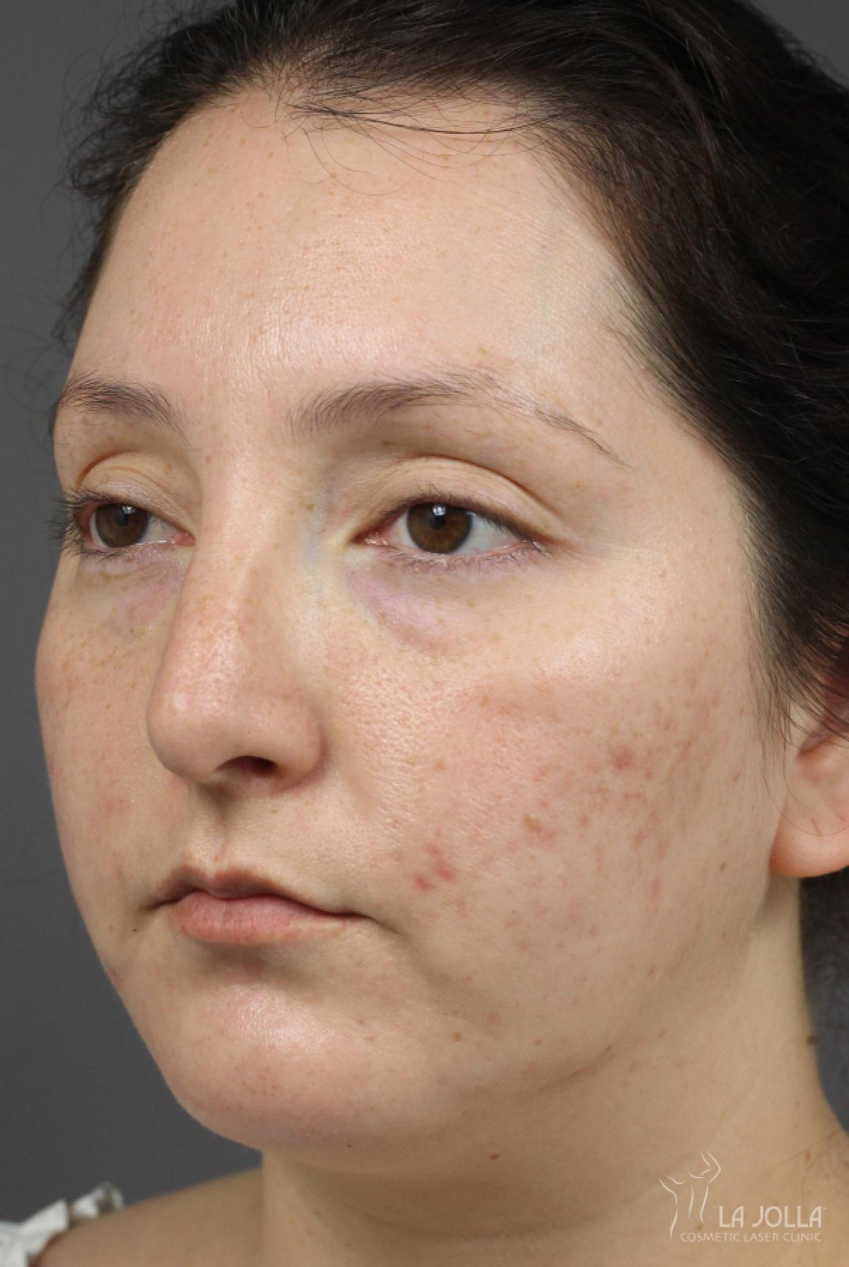 Acne Rejuvenation: Patient 6 - After 1