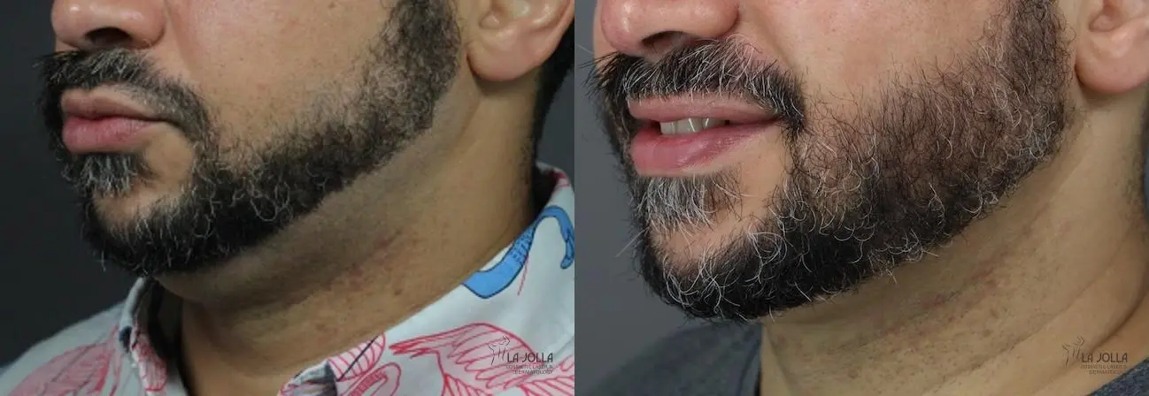 Kybella: Patient 8 - Before and After 2