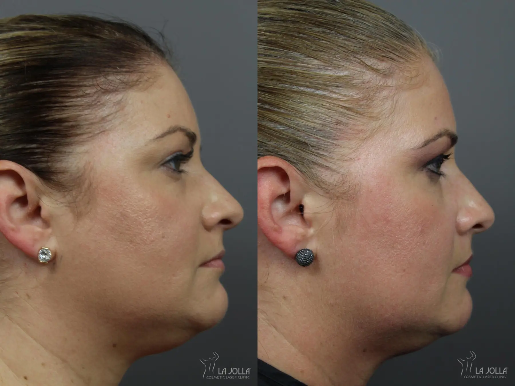 Kybella: Patient 1 - Before and After 1