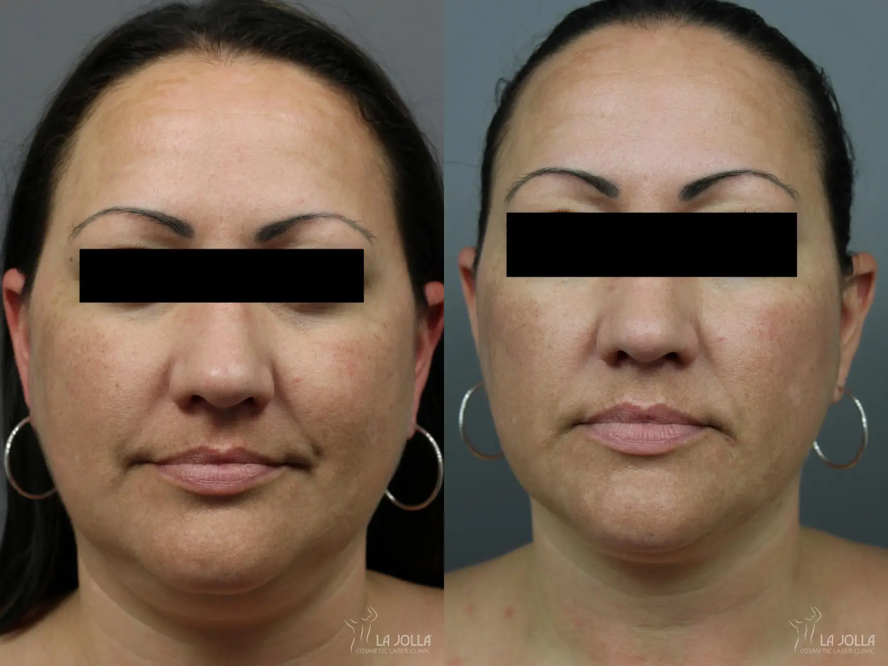 Kybella: Patient 7 - Before and After 2