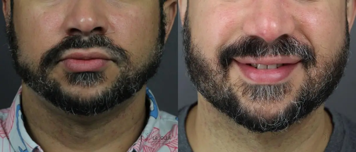 Kybella: Patient 8 - Before and After 1