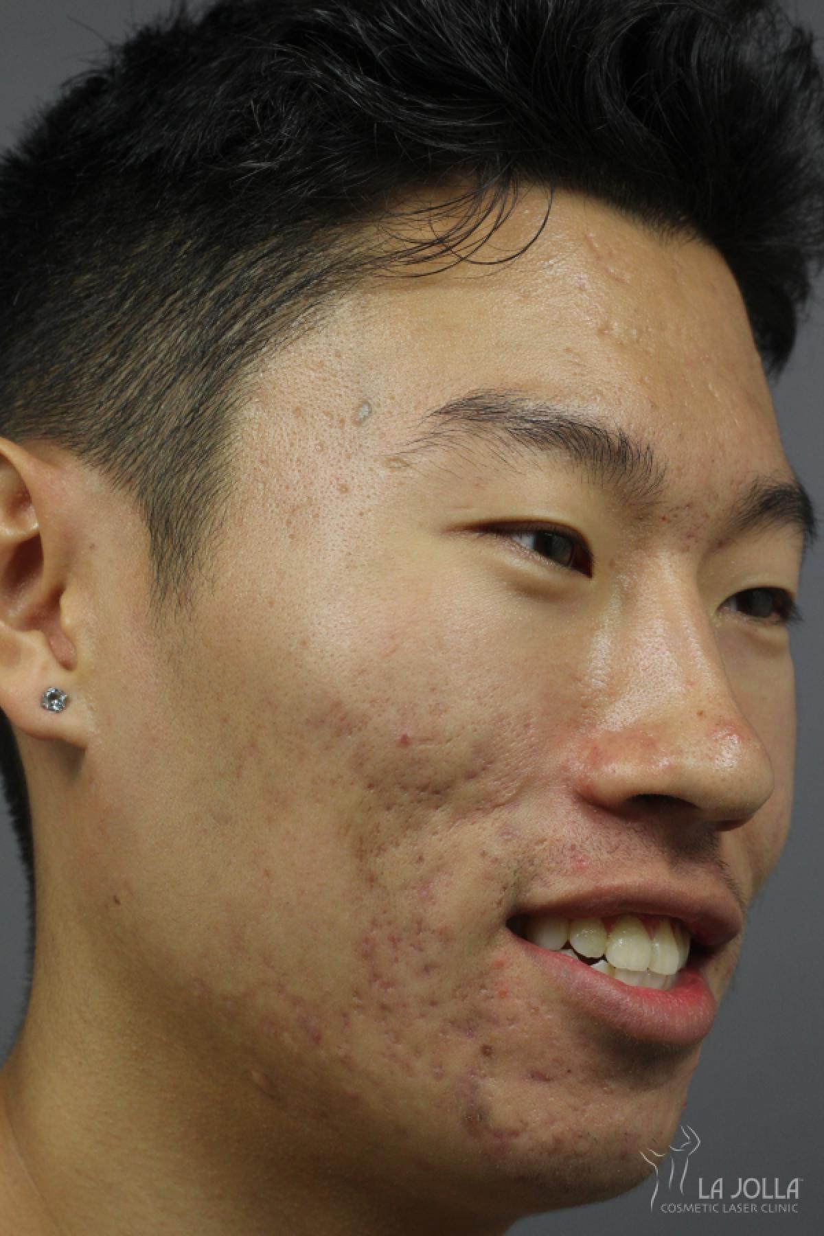 StarWalker® Laser: Patient 4 - Before 