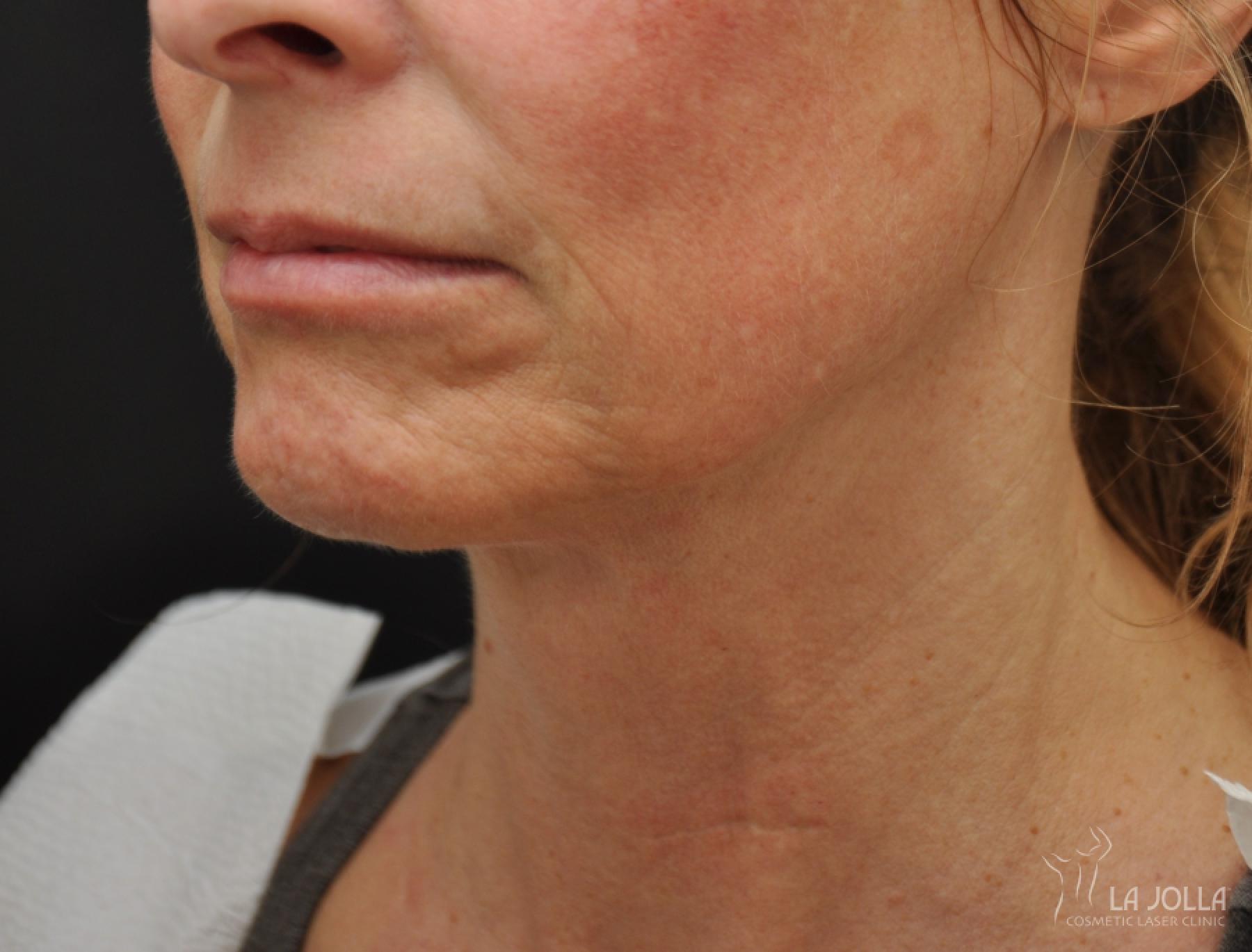 Ultherapy®: Patient 4 - Before 