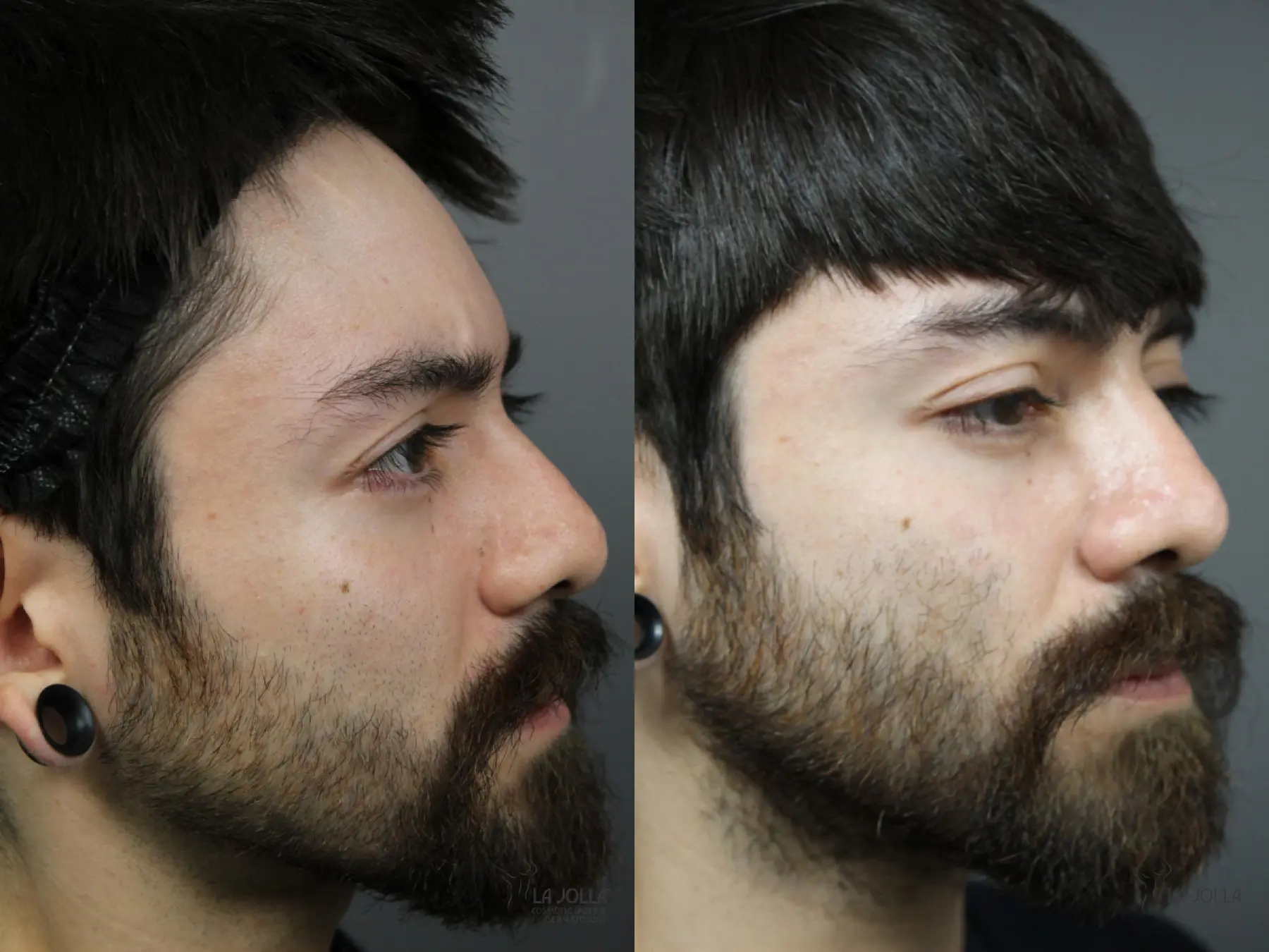 Laser For Rhinophyma: Patient 1 - Before and After 3