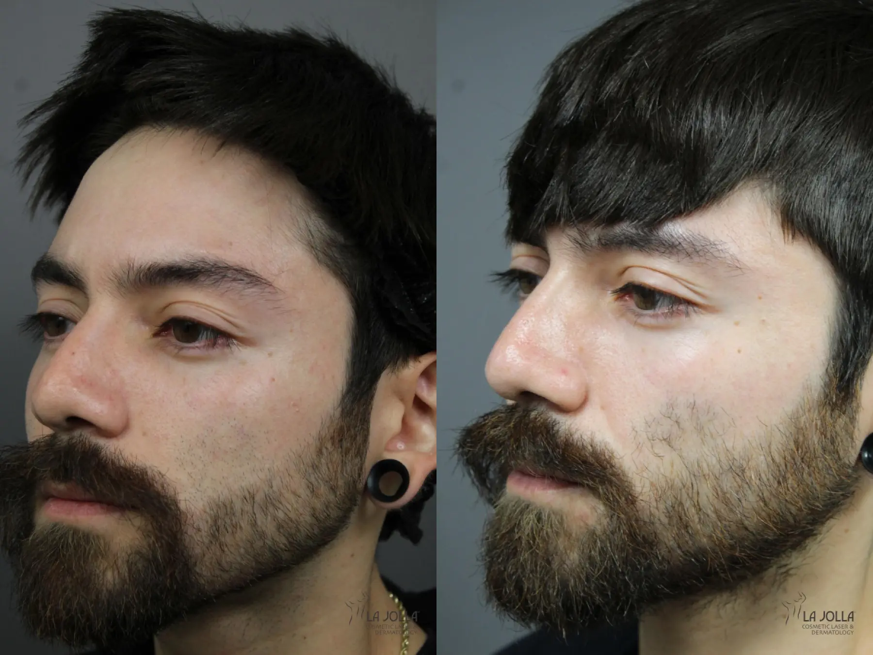 Laser For Rhinophyma: Patient 1 - Before and After 2