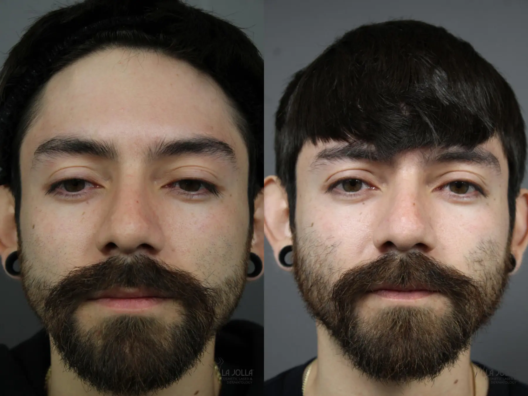 Laser For Rhinophyma: Patient 1 - Before and After 1