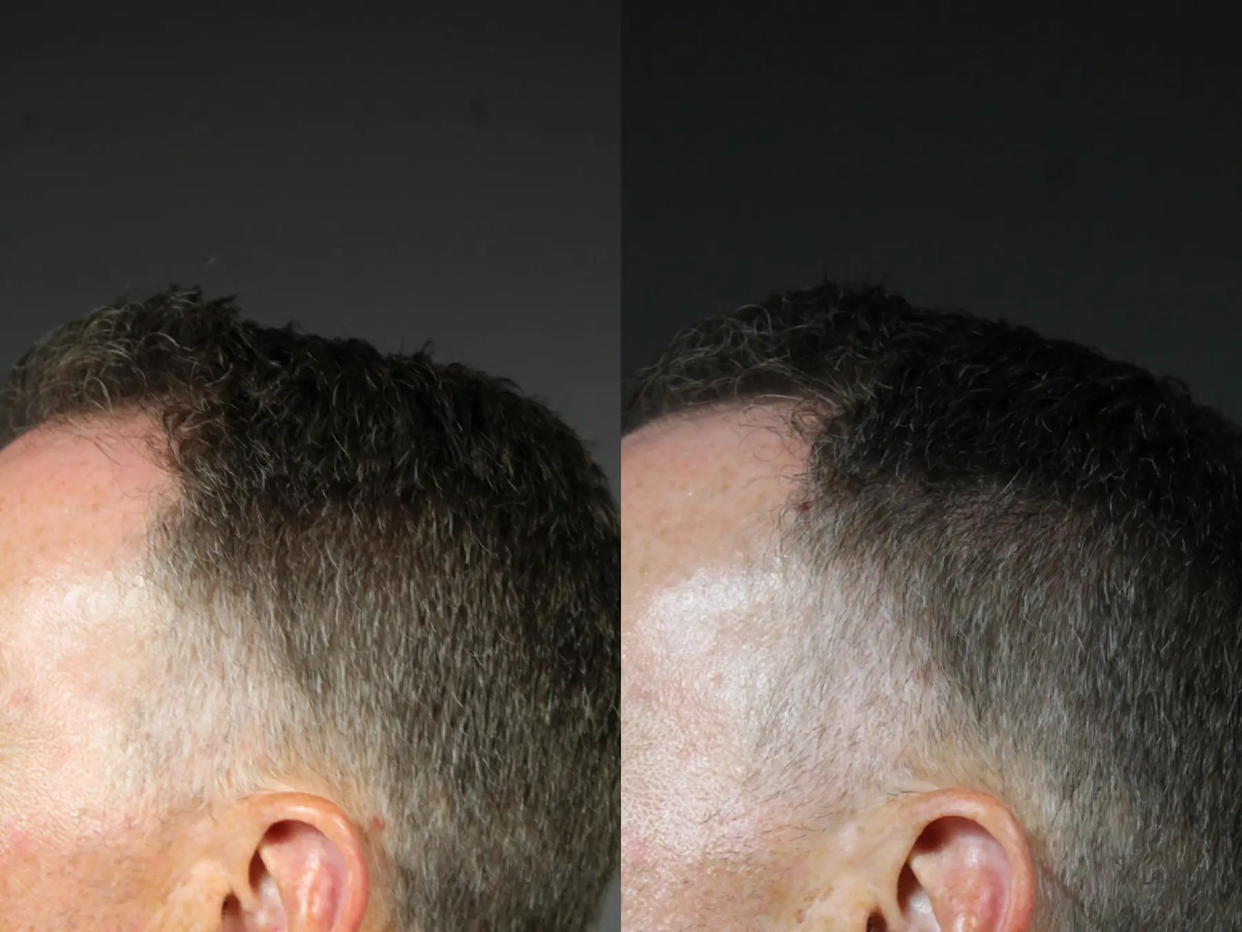 Laser Hair Growth: Patient 3 - Before and After 4