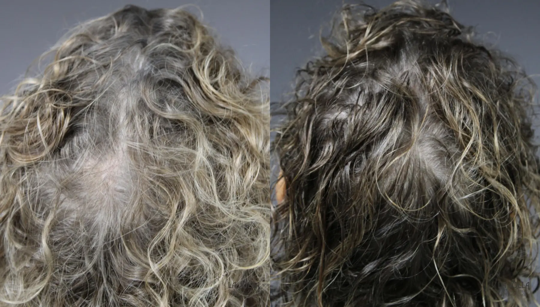 Laser Hair Growth: Patient 1 - Before and After 2