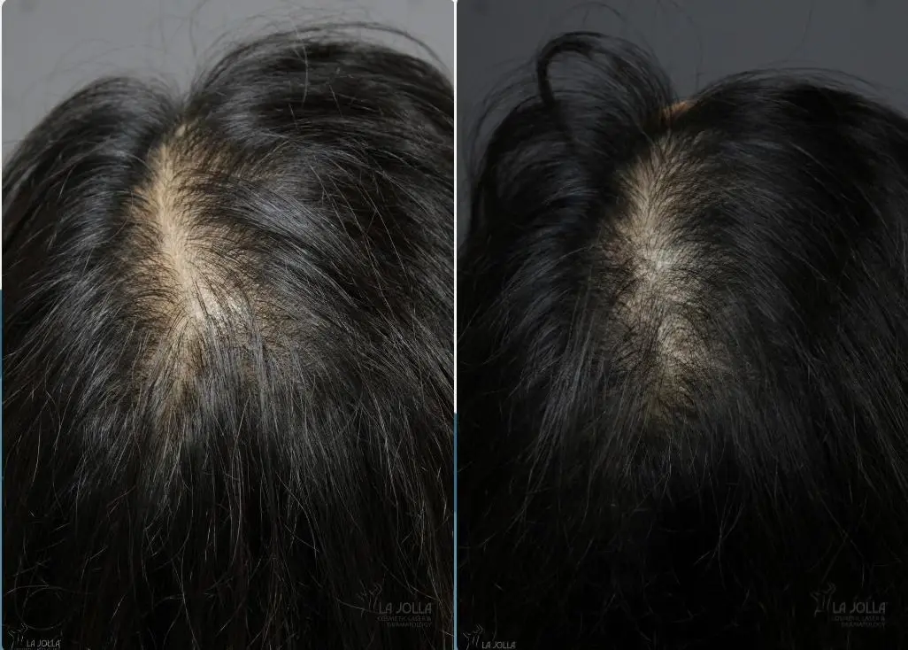 Laser Hair Growth: Patient 1 - Before and After  