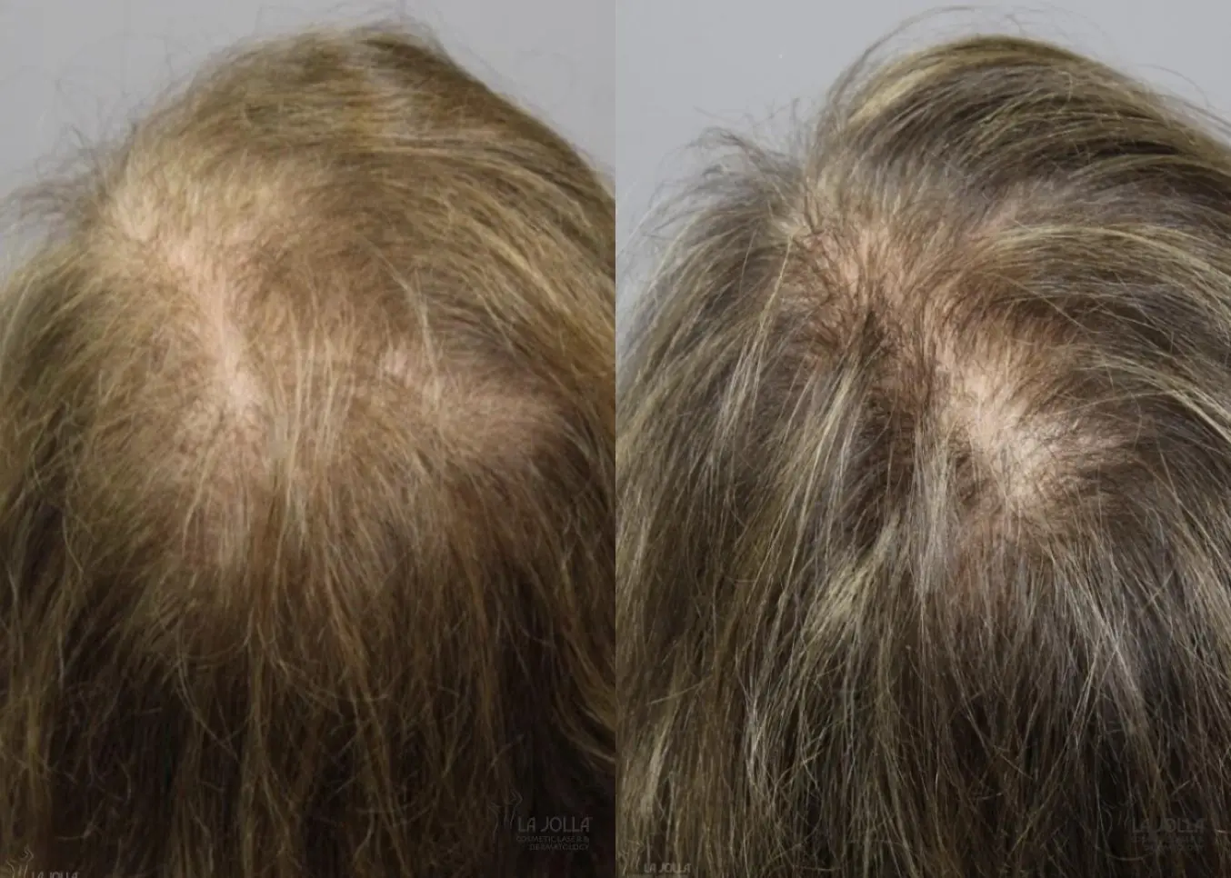 Laser Hair Growth: Patient 2 - Before and After  