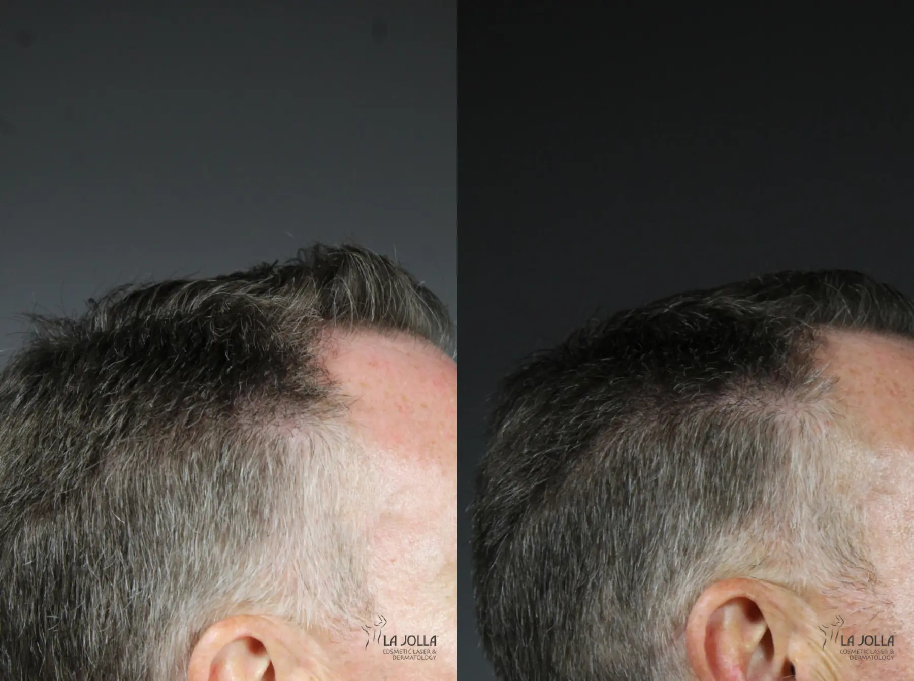 Laser Hair Growth: Patient 3 - Before and After 3
