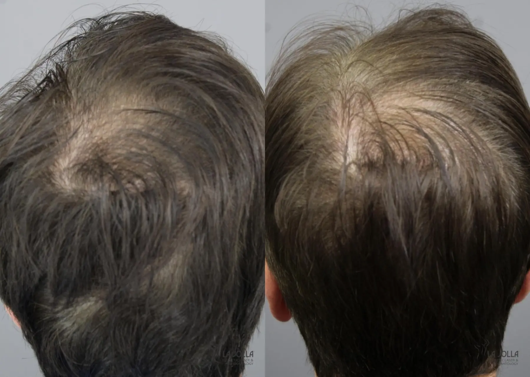 Laser Hair Growth: Patient 5 - Before and After