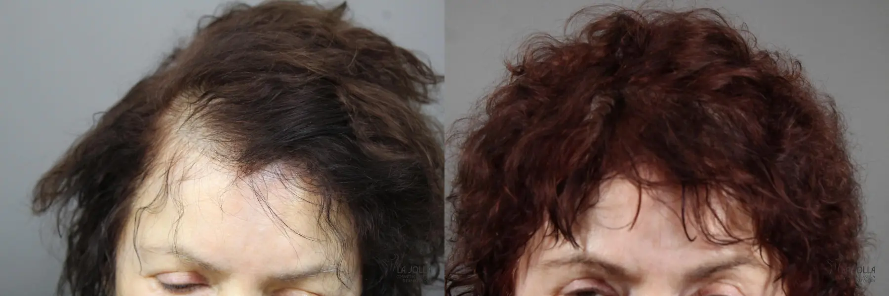 Laser Hair Growth: Patient 4 - Before and After 2