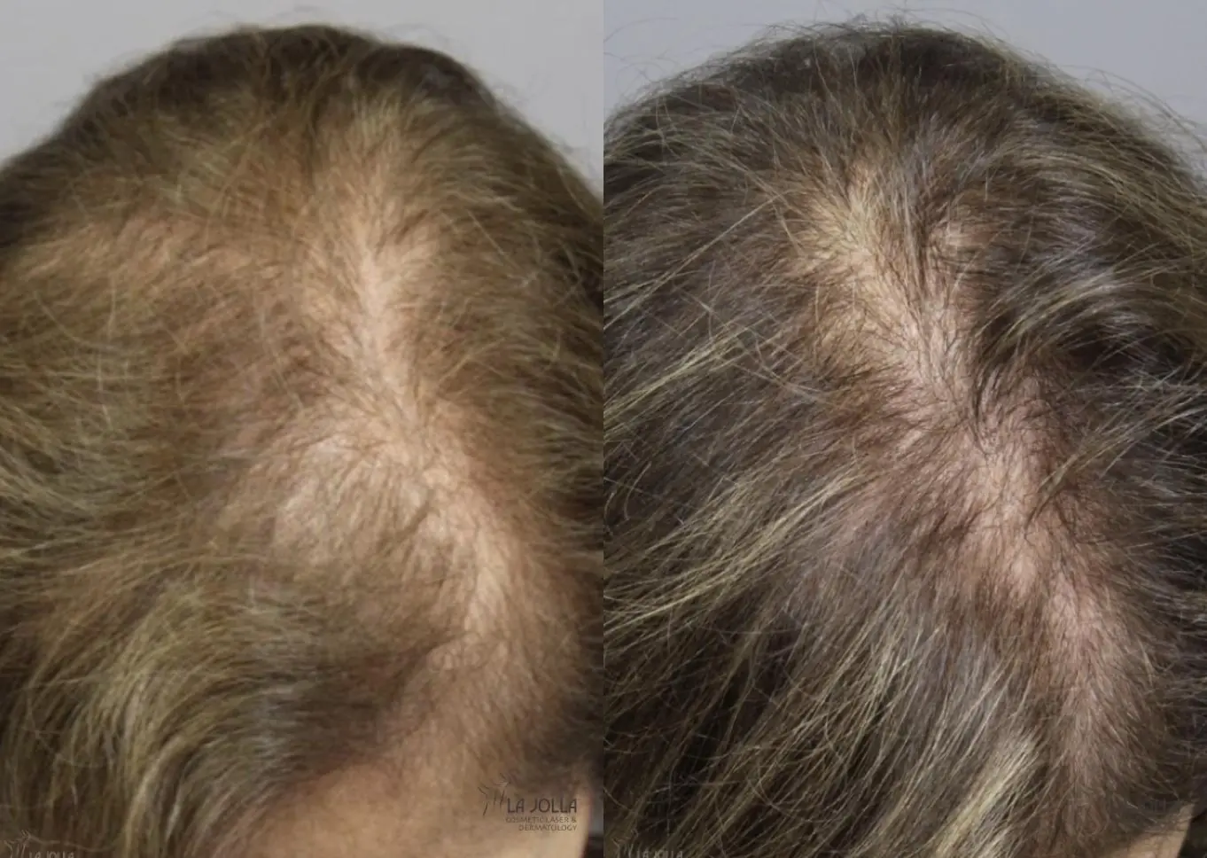 Laser Hair Growth: Patient 2 - Before and After 2
