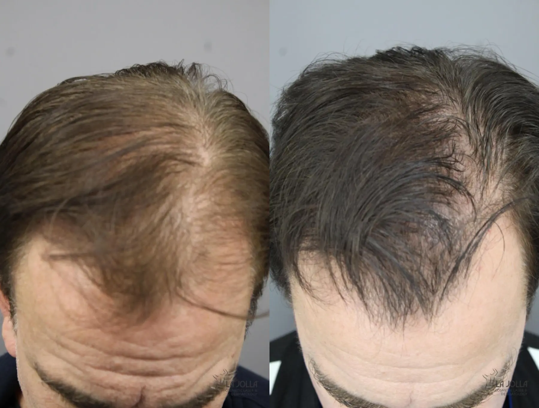 Laser Hair Growth: Patient 6 - Before and After 2
