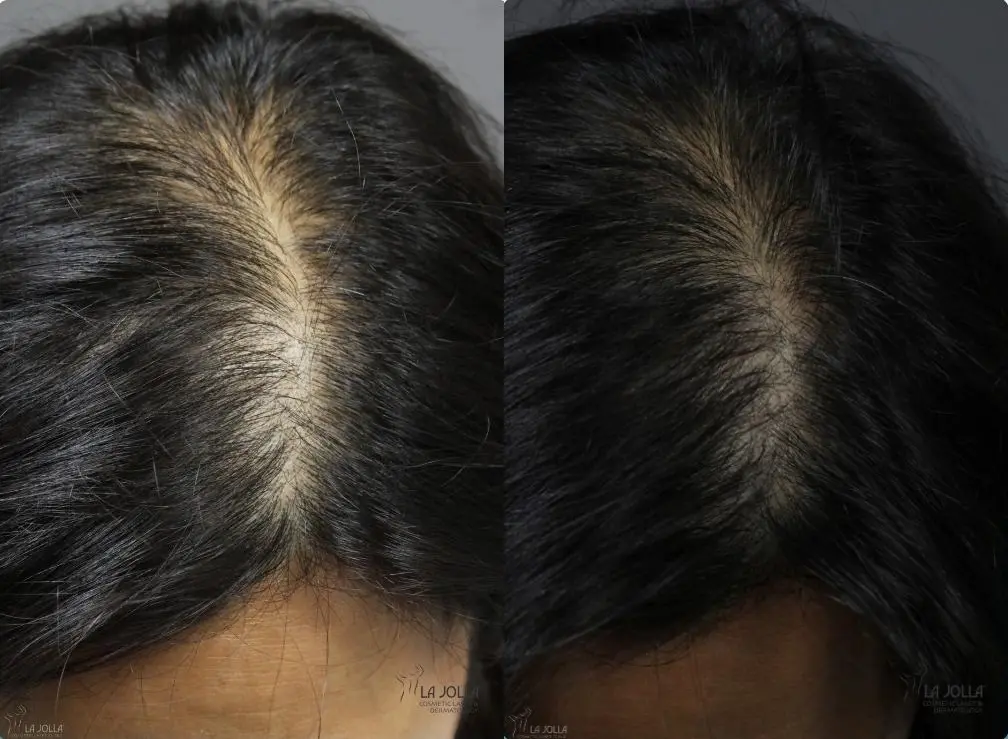 Laser Hair Growth: Patient 1 - Before and After 2