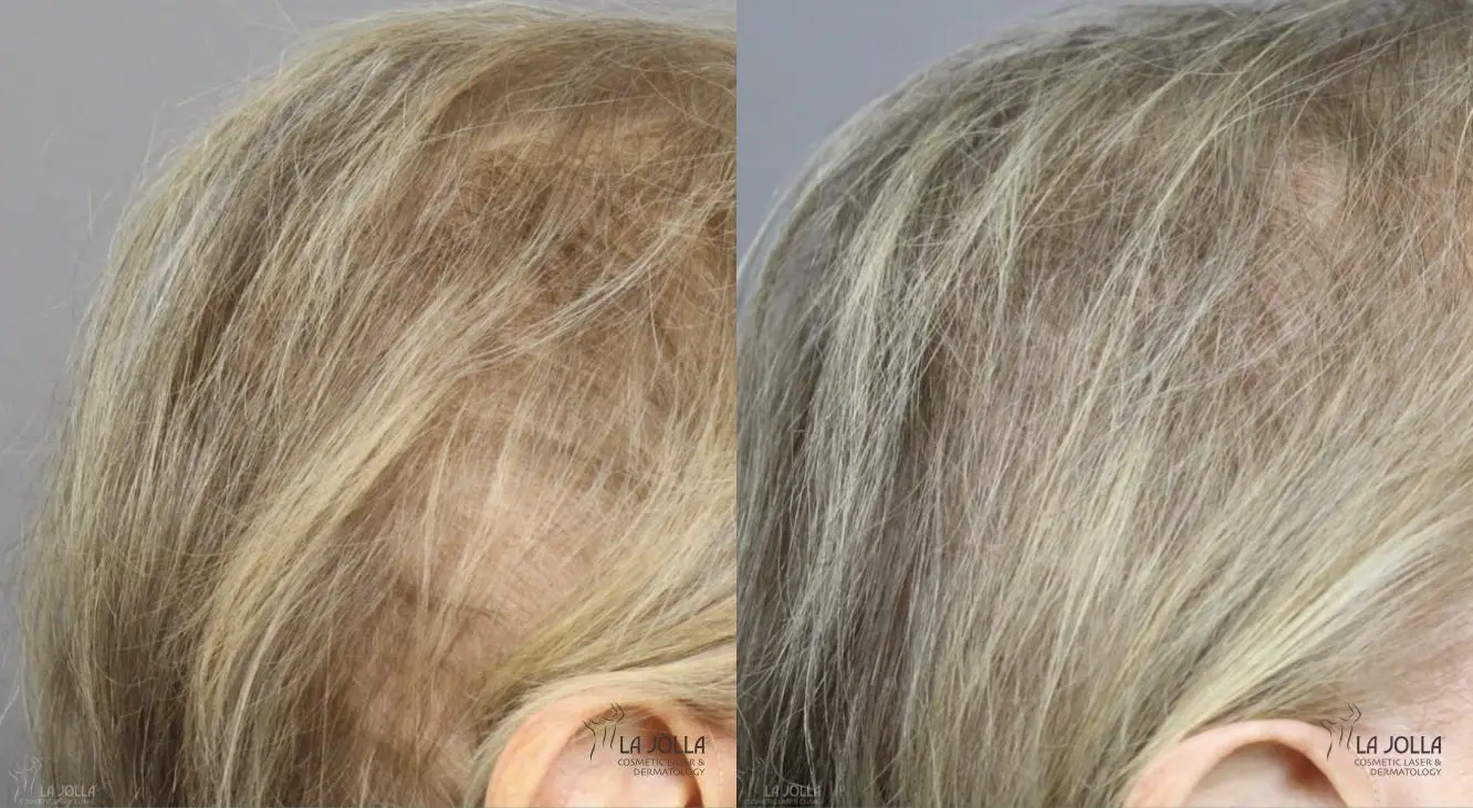 Laser Hair Growth: Patient 1 - Before and After 2