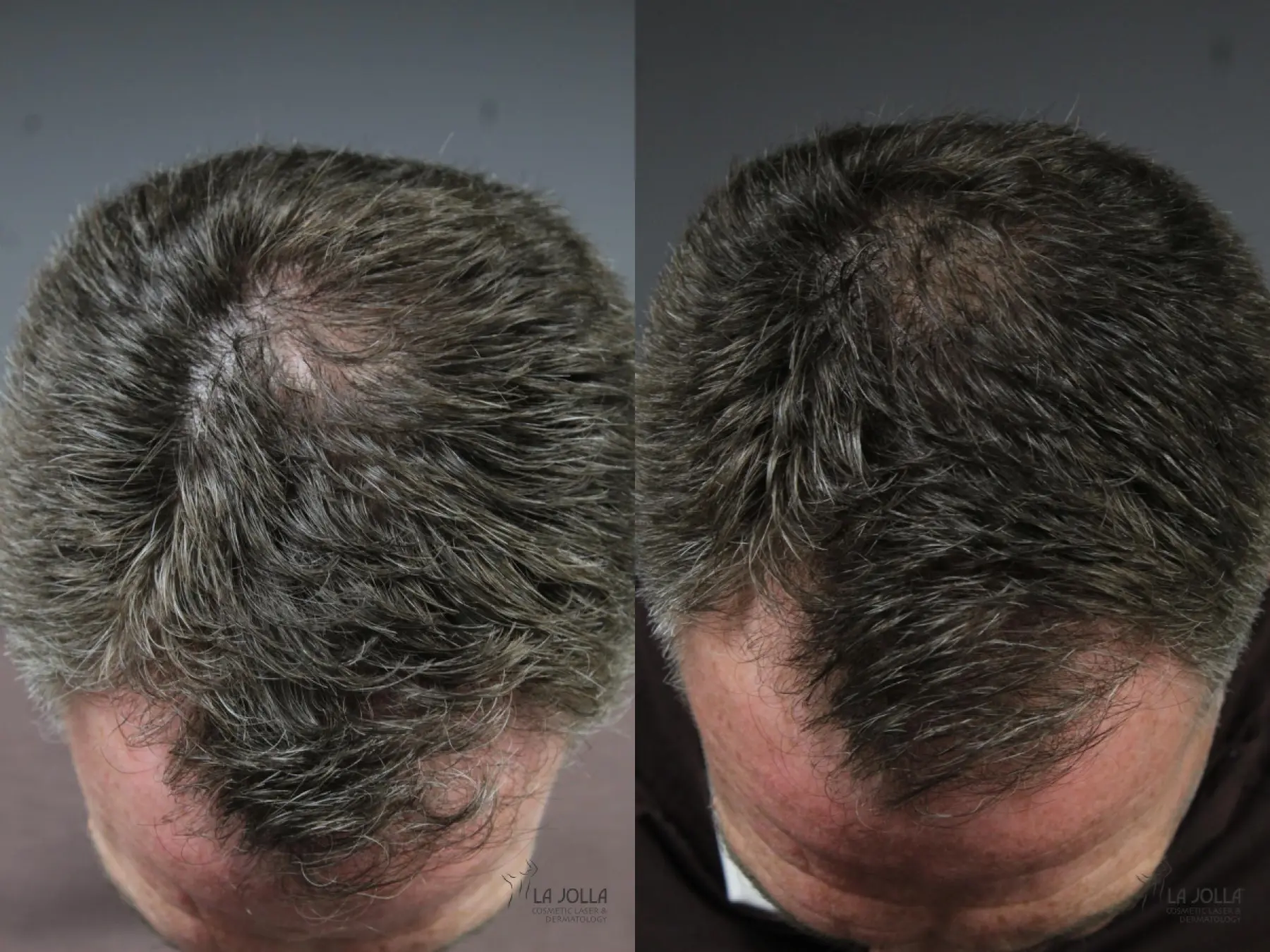Laser Hair Growth: Patient 3 - Before and After 2