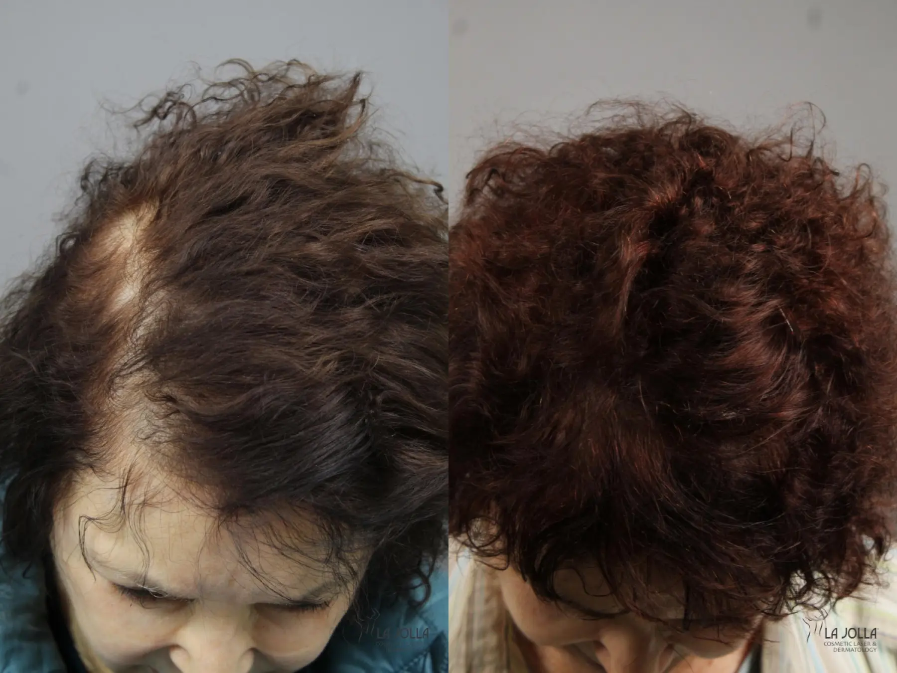 Laser Hair Growth: Patient 3 - Before and After