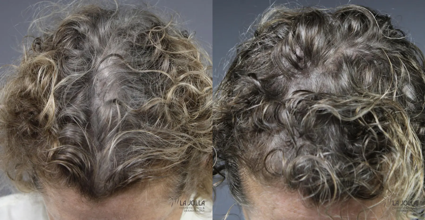 Laser Hair Growth: Patient 1 - Before and After 1