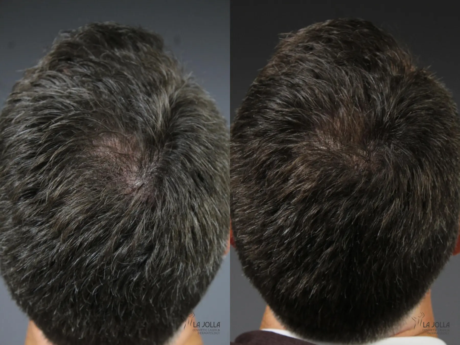 Laser Hair Growth: Patient 2 - Before and After