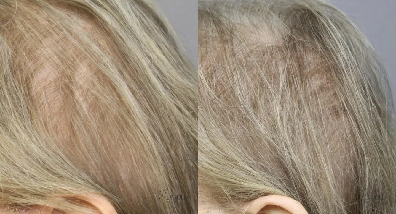 Laser Hair Growth: Patient 1 - Before and After 3