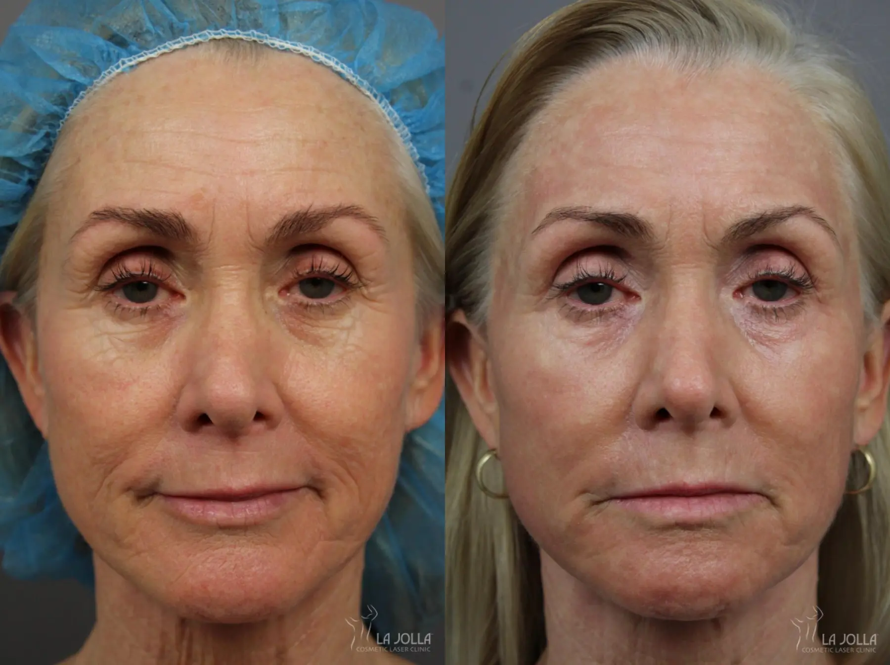 Laser Skin Resurfacing: Patient 1 - Before and After  