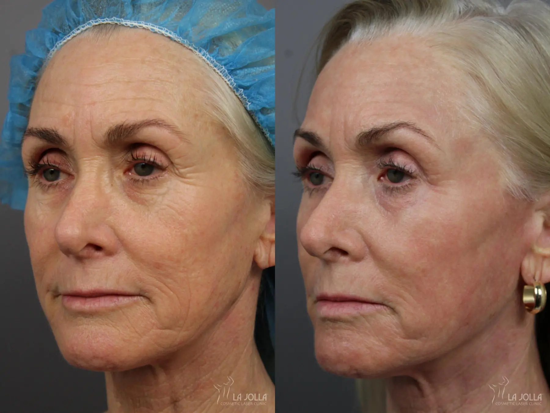Laser Skin Resurfacing: Patient 1 - Before and After 3