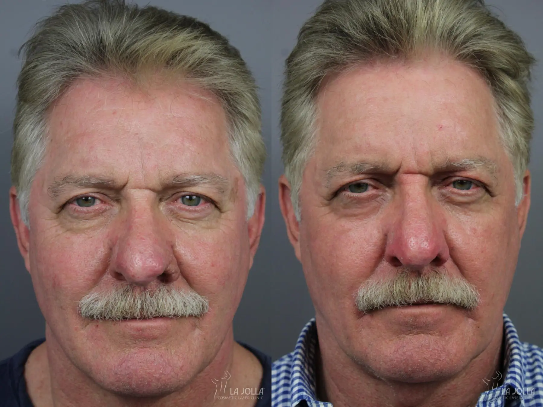 Laser For Rhinophyma: Patient 1 - Before and After 2