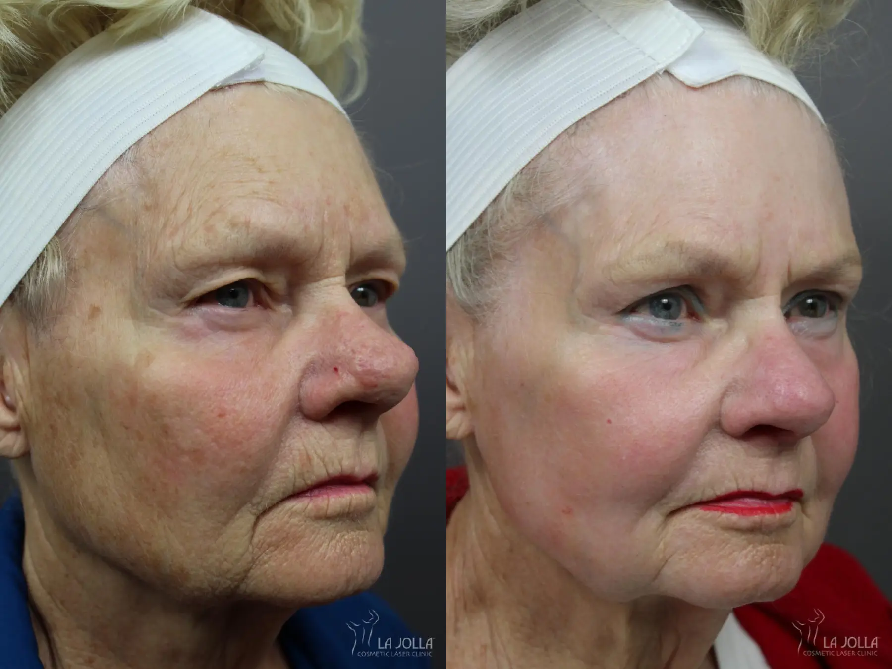 Laser For Rhinophyma: Patient 2 - Before and After 1