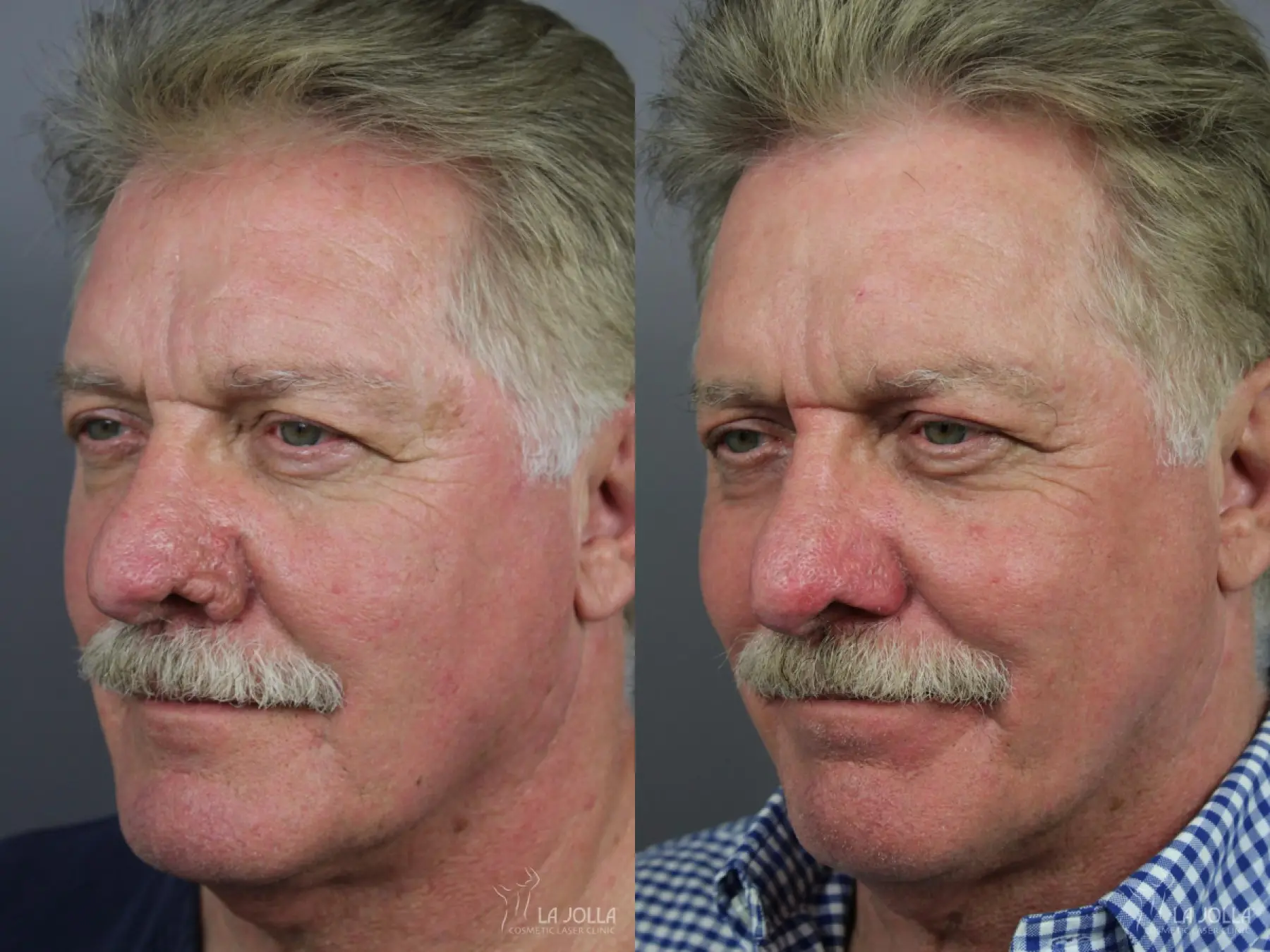 Laser For Rhinophyma: Patient 1 - Before and After 1