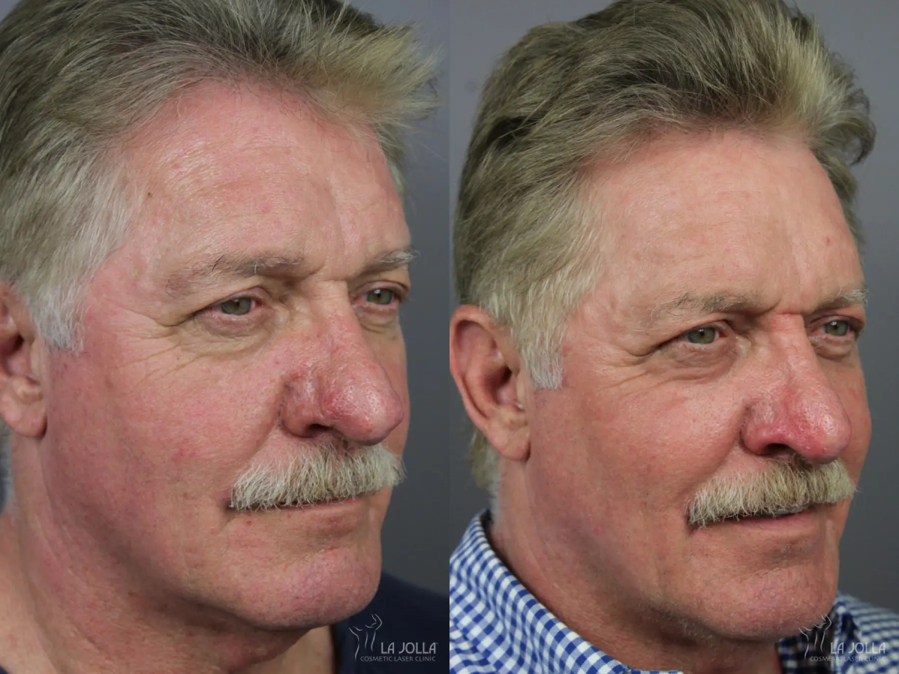 Laser For Rhinophyma: Patient 1 - Before and After 3