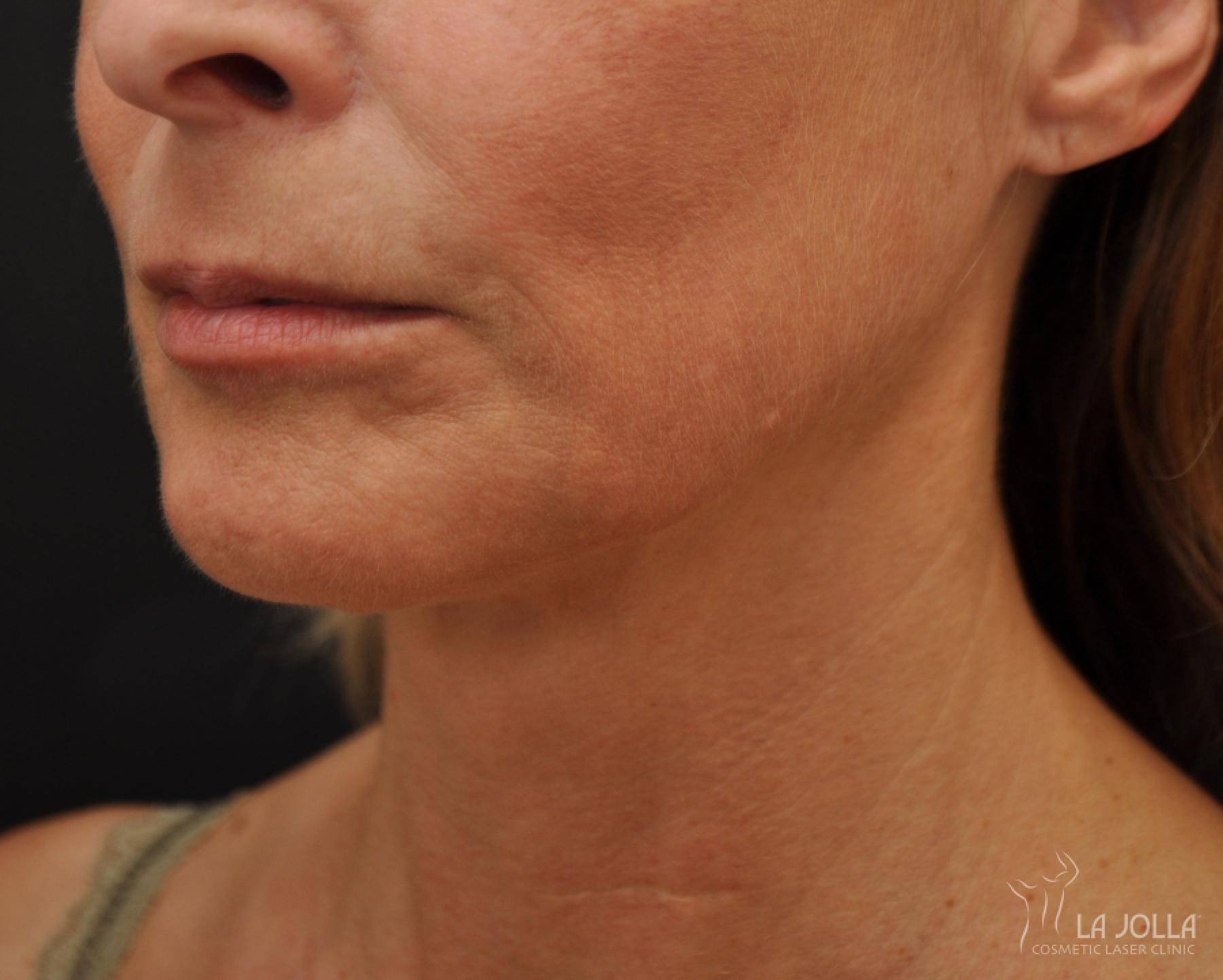 Ultherapy®: Patient 4 - After  