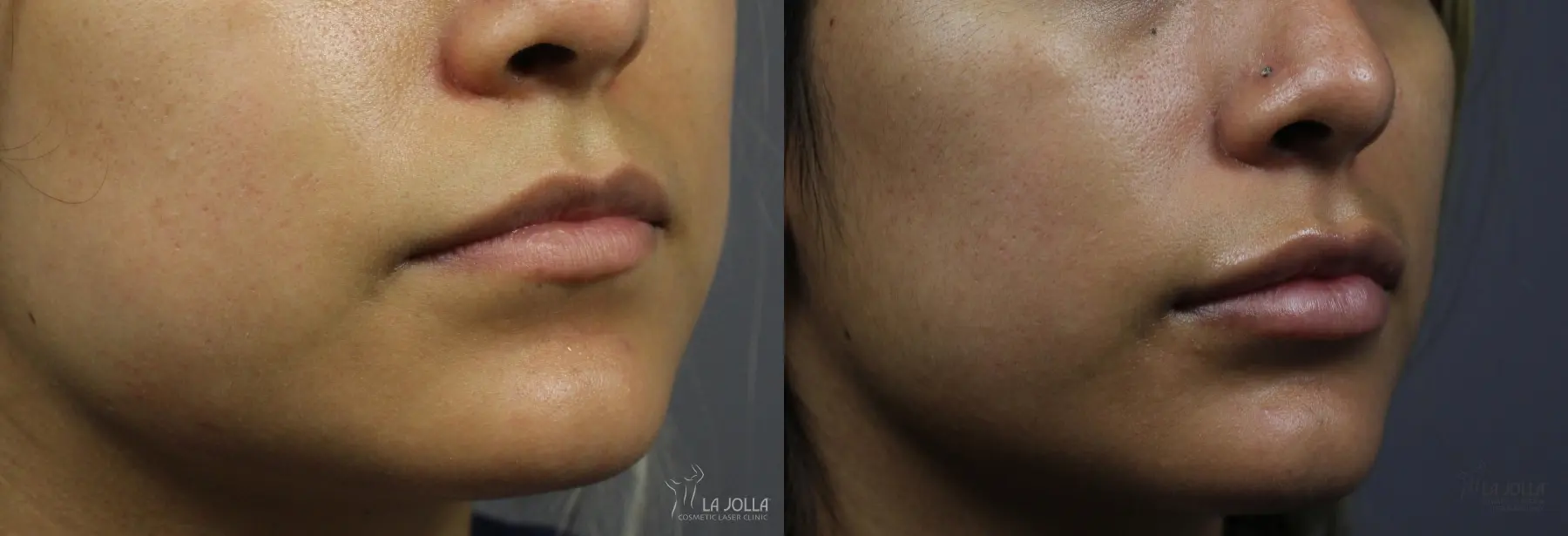 Lip Filler: Patient 14 - Before and After 2