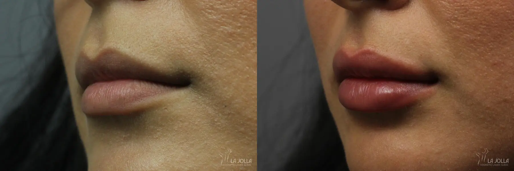 Lip Filler: Patient 1 - Before and After 1
