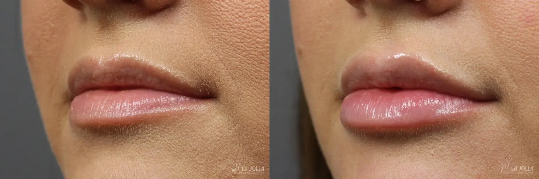 Lip Filler: Patient 8 - Before and After 1