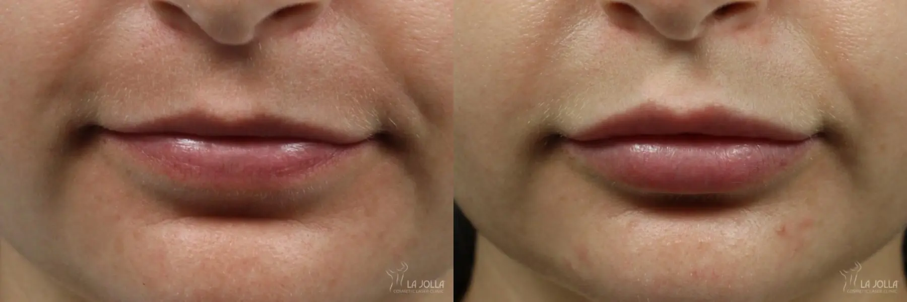 Lip Filler: Patient 6 - Before and After 1