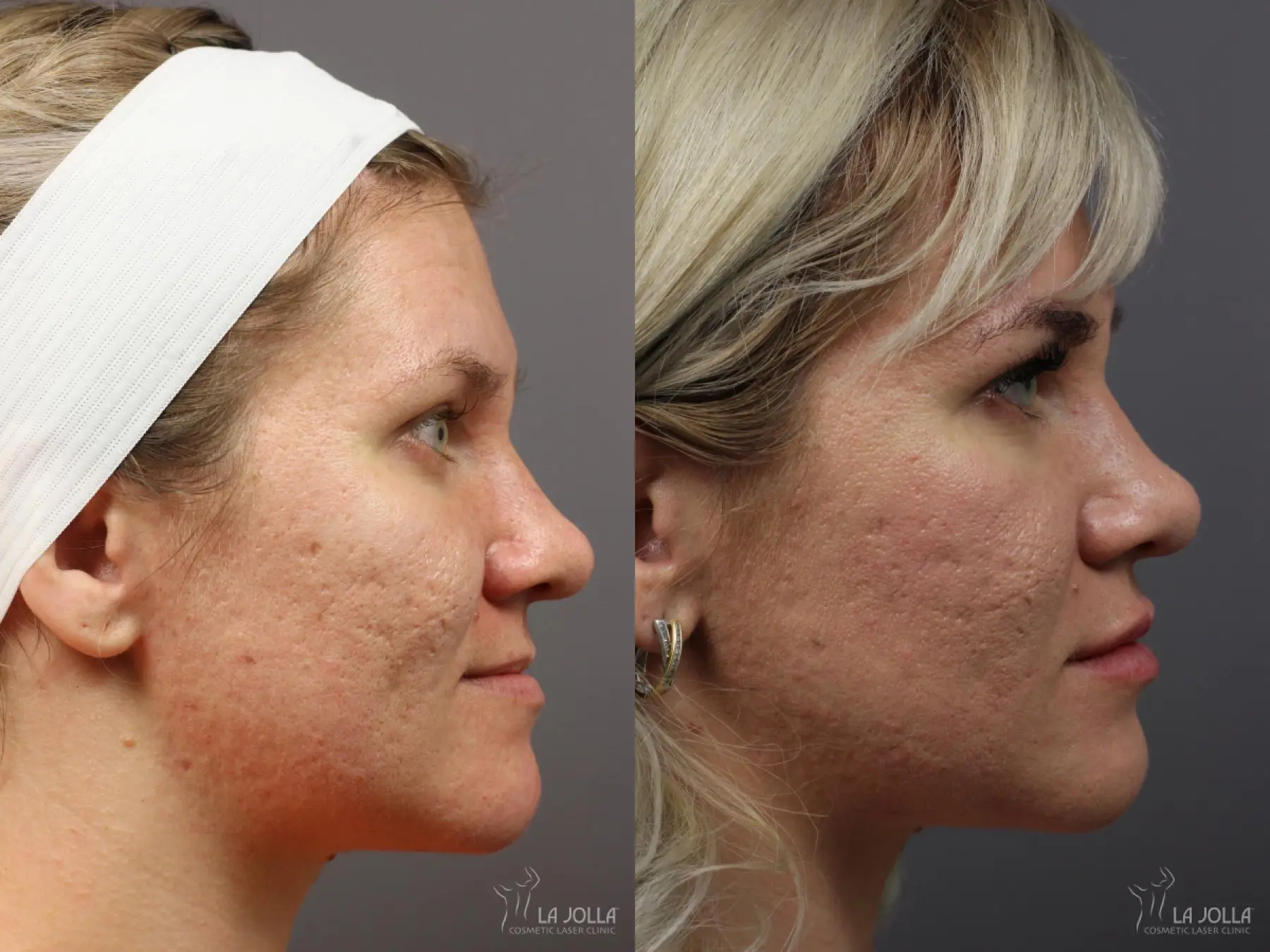 Lip Filler: Patient 5 - Before and After 1