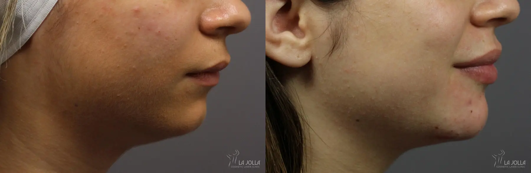 Lip Filler: Patient 17 - Before and After 1